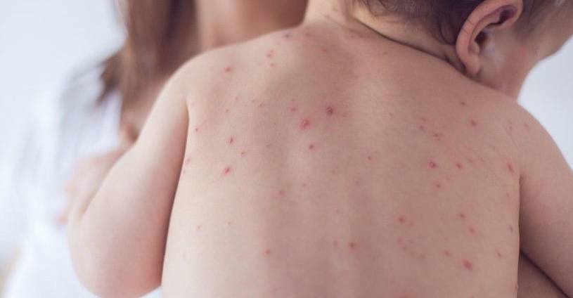 Varicella Vaccine Yeung Ho Hong - 楊浩康醫生